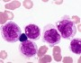 Acute monocytic leukemia