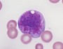 Acute promyelocytic leukemia