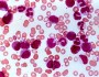 Myeloproliferative disorders