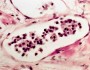 Vascular invasion