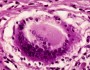 Subacute granulomatous thyroiditis