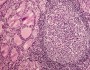 Hashimoto thyroiditis