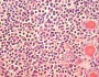 Lymphocytic thyroiditis