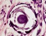 Psammoma bodies