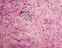 Reidel thyroiditis