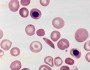 Sickle cell anemia