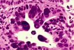 Metaplasia vs. neoplasia