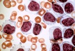 CLL vs. benign lymphocytosis