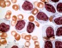 CLL vs. benign lymphocytosis