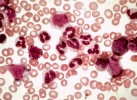 CML vs. benign neutrophilia