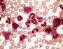 CML vs. benign neutrophilia