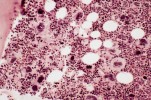 Four similarities shared by all myeloproliferative disorders