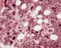 Four similarities shared by all myeloproliferative disorders