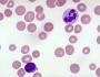 Anemia quiz