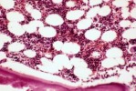 What does normal bone marrow look like?