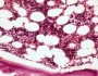 What does normal bone marrow look like?