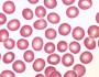 What do normal red blood cells look like?