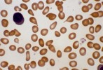 Teardrop red cells