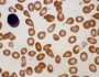Teardrop red cells
