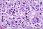 Anaplasia