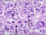 Anaplasia