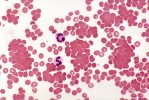 Cold autoimmune hemolytic anemia