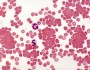 Cold autoimmune hemolytic anemia