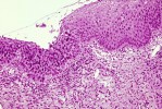 What’s the connection between dysplasia and neoplasia?