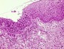 What’s the connection between dysplasia and neoplasia?