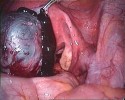 Endometriosis: how does it happen?