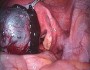 Endometriosis: how does it happen?
