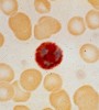 Leukocyte alkaline phosphatase