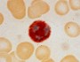 Leukocyte alkaline phosphatase