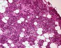 What does normal parathyroid tissue look like?