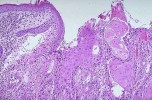 Tumor differentiation
