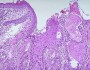 Tumor differentiation