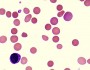 Warm autoimmune hemolytic anemia