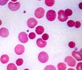 How do you know if an anemia is hemolytic?