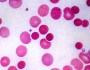 How do you know if an anemia is hemolytic?