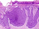Tumor cell differentiation