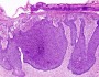 Tumor cell differentiation
