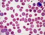 Hematology clinical vignette