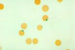 Glucose 6 phosphate dehydrogenase deficiency