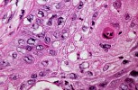 Undifferentiated tumors: solving the mystery