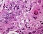 Undifferentiated tumors: solving the mystery