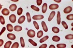 Hereditary elliptocytosis