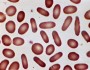 Hereditary elliptocytosis