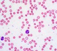 Hereditary spherocytosis