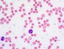 Hereditary spherocytosis