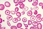 Thalassemia